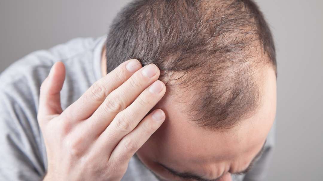 MinoxidilMax contro l’Alopecia Androgenetica